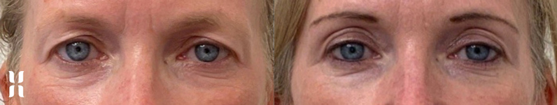 AgeJET Plasma is  a non-surgical option for blepharoplasty 